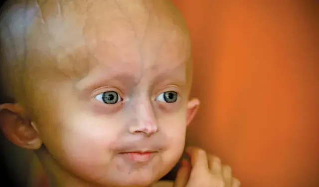 Progeria Nedir, Belirtileri Nelerdir ve Nasıl Teşhis Edilir? Bu Hastalık Neden Yaşlanmayı Hızlandırır?