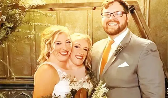 Doktorlar ‘Uzun Yaşayamazlar’ Demişti... Yapışık İkizler Anne Oldu