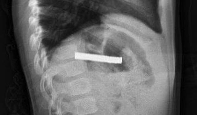 3 yaşındaki çocuğun boğazından 19 mıknatıs parçası çıkarıldı