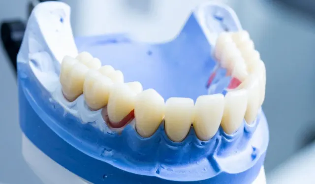 Diş Protezi Uygulama Süreci Nasıl İşler?