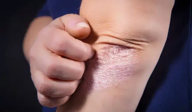 Egzama Belasını Hafifletmek İçin Denemeniz Gereken 13 Doğal ve Etkili Malzeme Nelerdir?