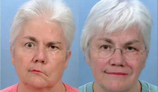 Ramsay Hunt Sendromu Nedir? Yüz Felcine Yol Açabilen Bu Gizemli Hastalık Nasıl Ortaya Çıkıyor ve Belirtileri Nelerdir?