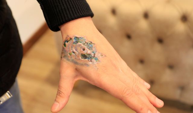 Dövme sildirmek isterken kabusu yaşadı, elindeki dokular öldü