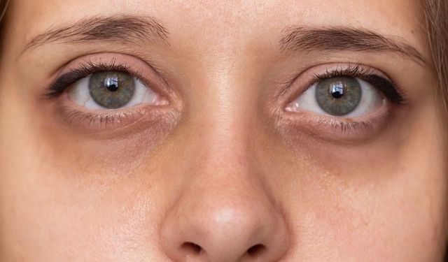 Sabahları Göz Altı Morlukları Neden Artar?