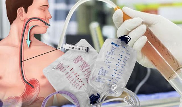 Mide Yıkanması Nedir, Hangi Durumlarda Yapılır ve Gerçekten Hayat Kurtarır Mı?