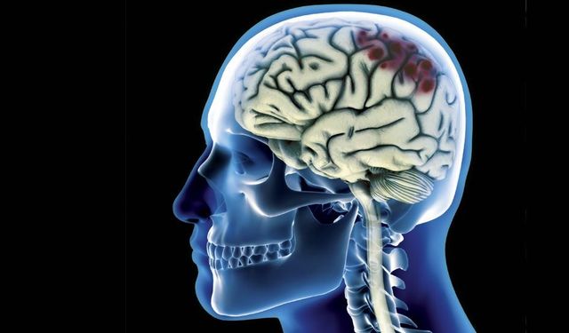 Kafa Travması Sonrası Sessiz Tehlike! Subdural Hematom Nedir, Belirtileri Neler?