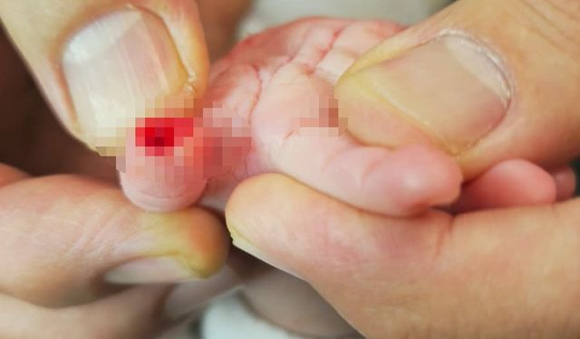 Serum çıkarma işlemi esnasında sargıyla birlikte bebeğin parmağı kesildi