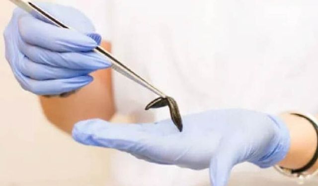Sülük Tedavisi Nedir? Faydaları ve Riskleri Hakkında Bilinmesi Gerekenler