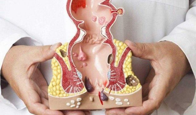 Hemoroid Tedavisinde Yeni Dönem! Kesi ve Dikiş Gerektirmeyen Lazer Yöntemi Dikkat Çekiyor