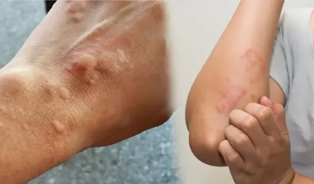 Yaz Sıcakları Kurdeşen Ataklarını Tetikleyebilir! İşte Dikkat Edilmesi Gerekenler