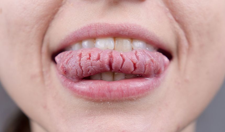 Dilinizde Harita Gibi Lekeler Mi Var, Harita Dil Nedir, Neden Ortaya Çıkar Ve Ne Zaman Ciddiye Alınmalı?