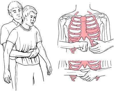 0x0-heimlich-manevrasi-nedir-nasil-yapilir-heimlich-ne-demektir-1647076714235