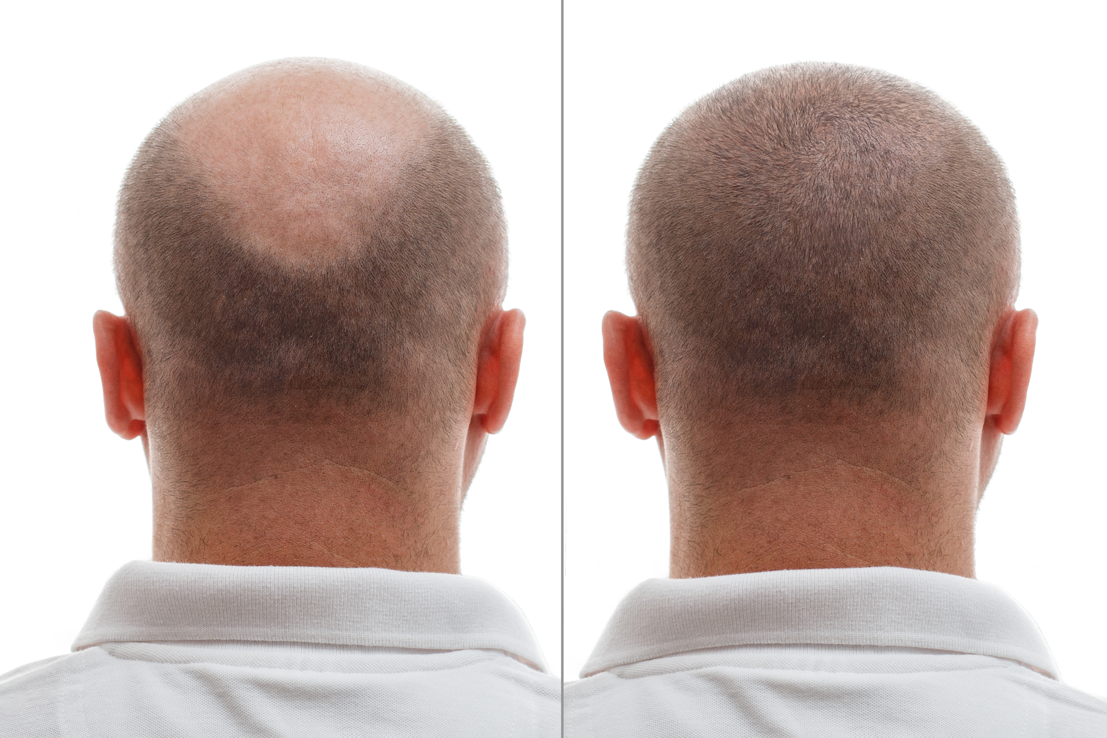 head-balding-man-before-after-hair-transplant-surgery-man-losing-his-hair-has-become (1)