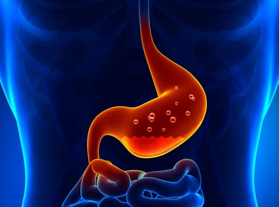 Midenizde Bunlar Oluyorsa Dikkat Edin! Gastroözofageal Reflü Hastalığı (Gerd) Ve Gerçekleri! (2)