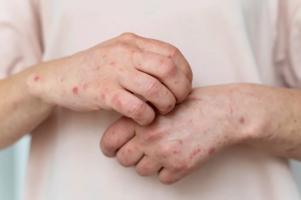 Genc Gazete Uyuz Hastaligi Uyuz Scabies(5)