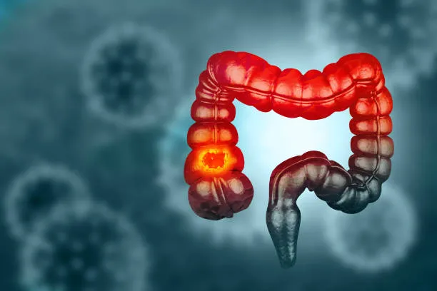 Kolon Kanseri 20’Li Yaşlarda Görülmeye Başladı