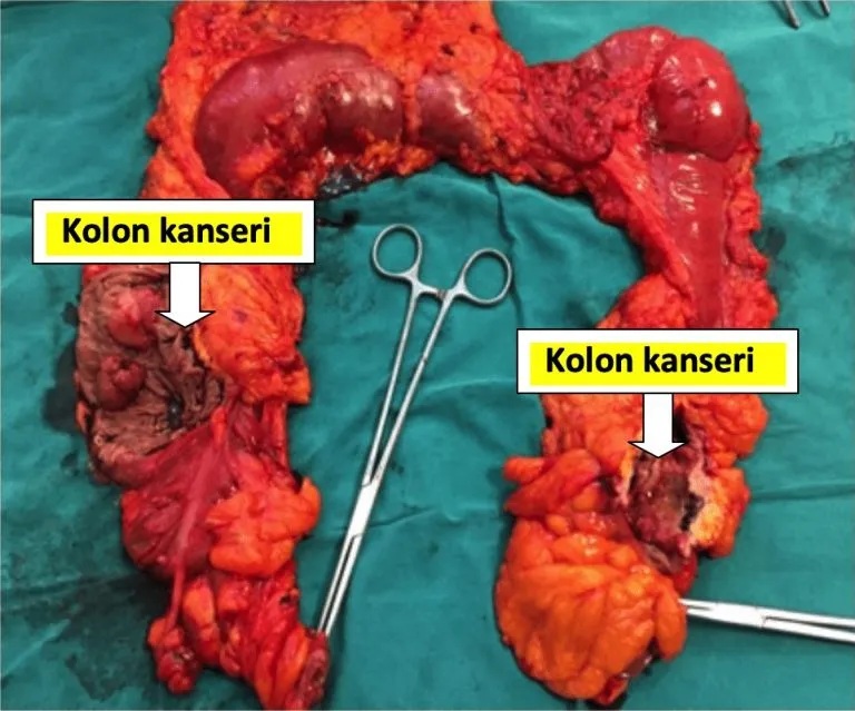 Kolon Rezeksiyonu Ameliyatı Nedir Notes Ve Sils Yöntemleri (5)