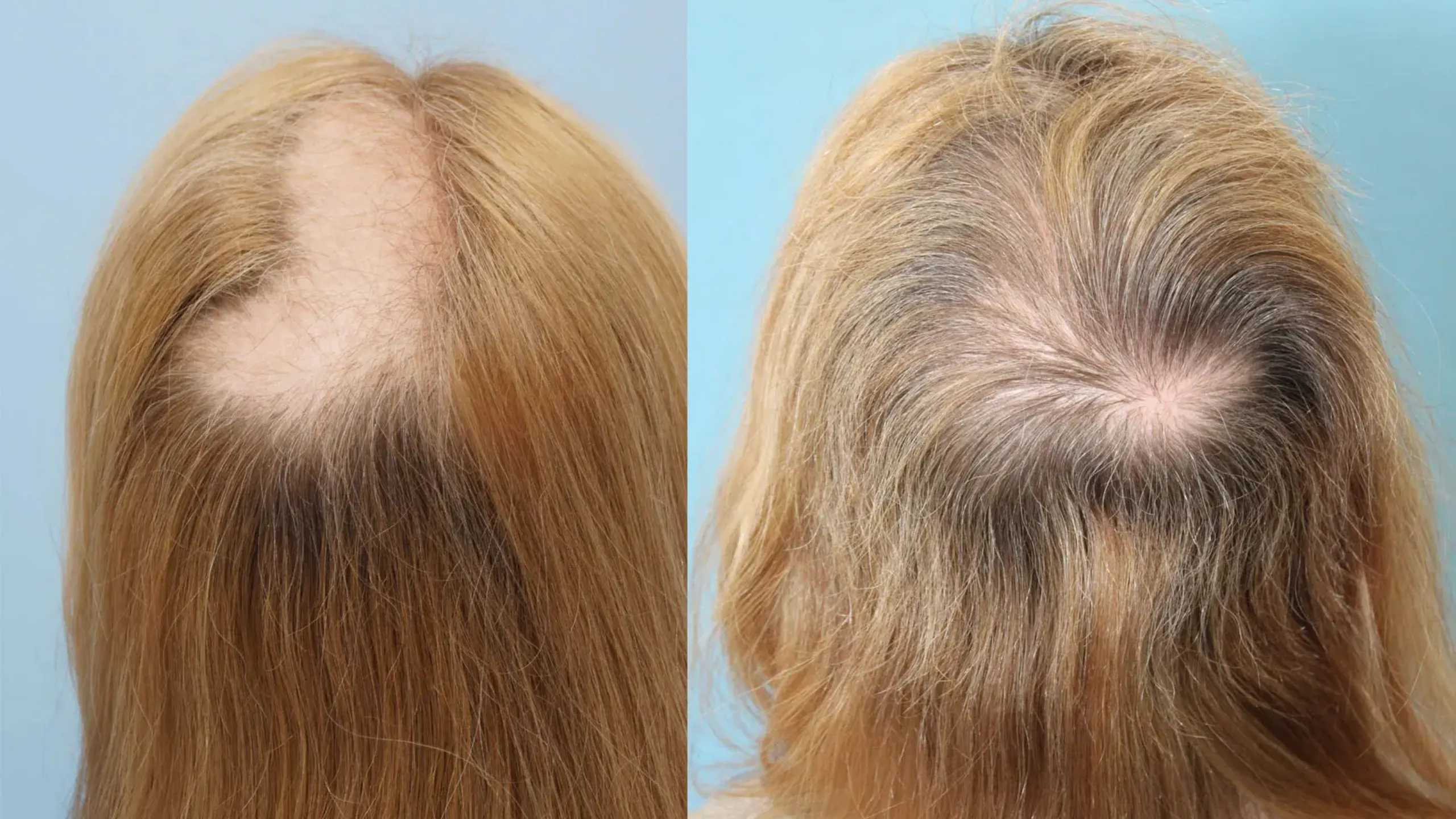 Trichotillomania Nedir Sac Kil Koparma Hastaligi Jpeg Trh7 Gencgazete