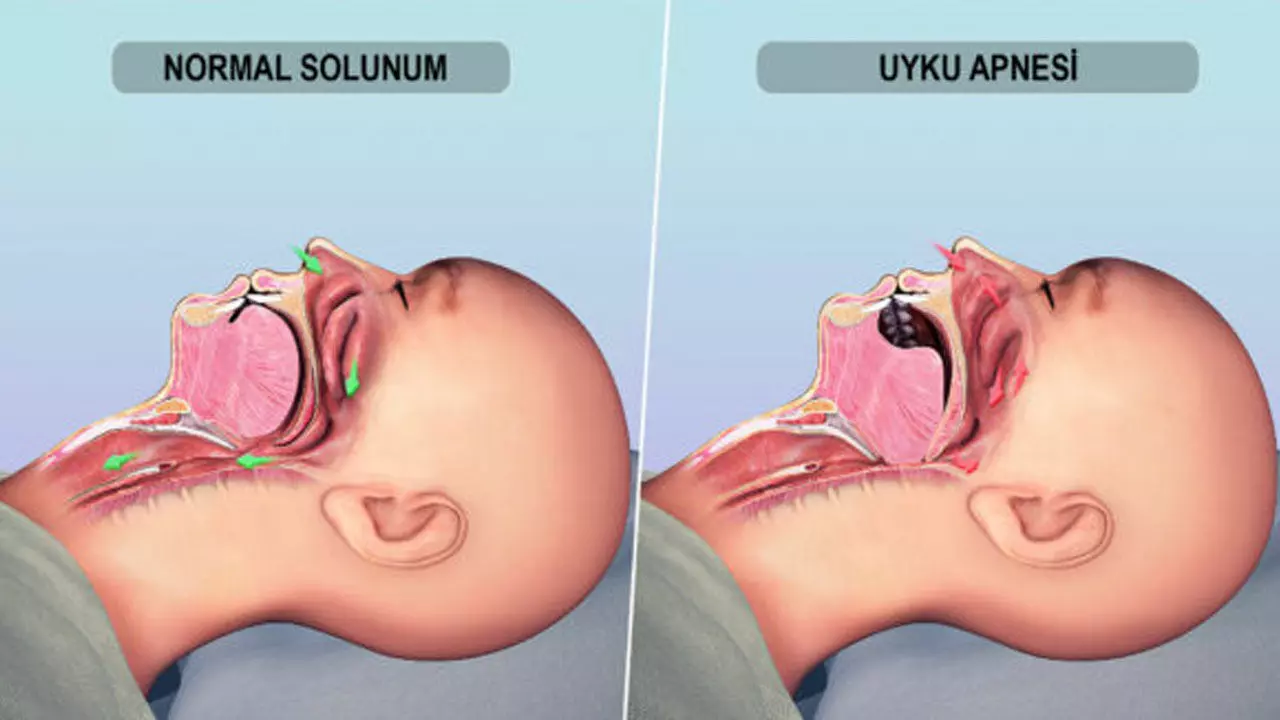 Uyku Apnesi Geceleri Nefesinizin Durduğunu Biliyor Musunuz (3)