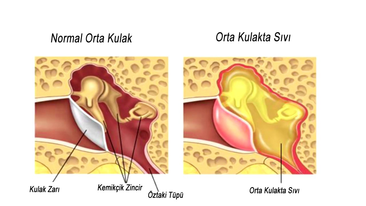 Ortakulaksivi