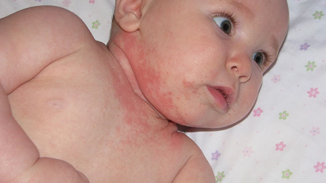 Genç Gazete Süt Alerjisi 2