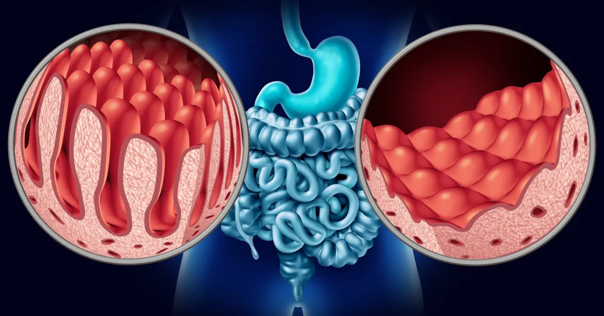 İnegöl'de Çölyak Hastalarını Düşünen Yok! (2)