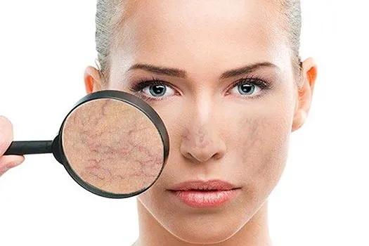 Kırmızı Damar Çatlaması Neden Olur Ve Nasıl Geçer Kırmızı Damarların Oluşumunu Engellemek İçin Bilinmesi Gerekenler! (1)