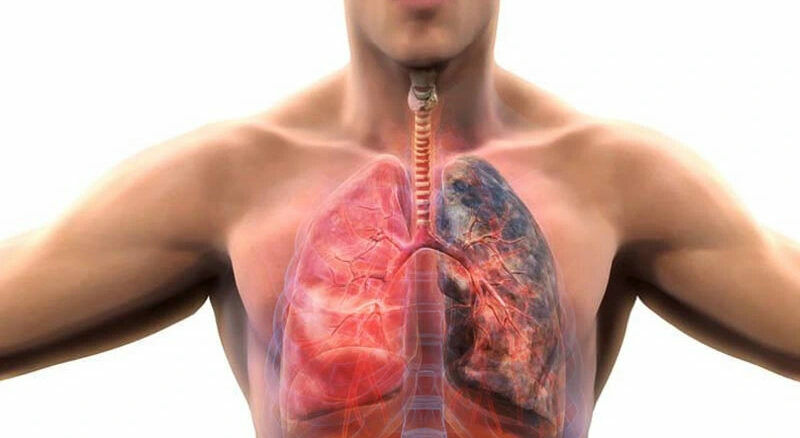 Koah’ın 7 Belirtisine Dikkat! Erken Tanı Hayat Kurtarıyor (4)