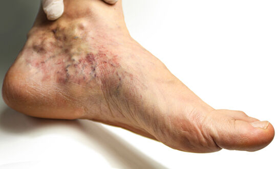 Kol Ve Bacaktaki Ani Ağrı Ve Soğukluk Ölümcül Olabilir! (1)