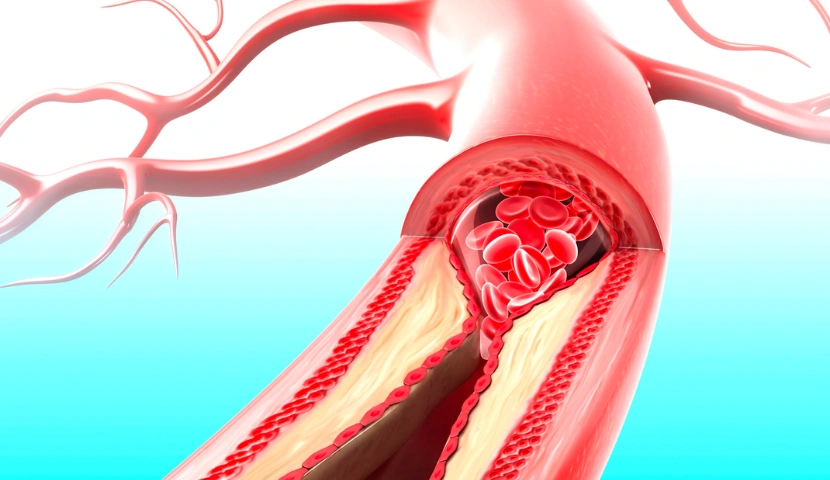 Kol Ve Bacaktaki Ani Ağrı Ve Soğukluk Ölümcül Olabilir! (2)