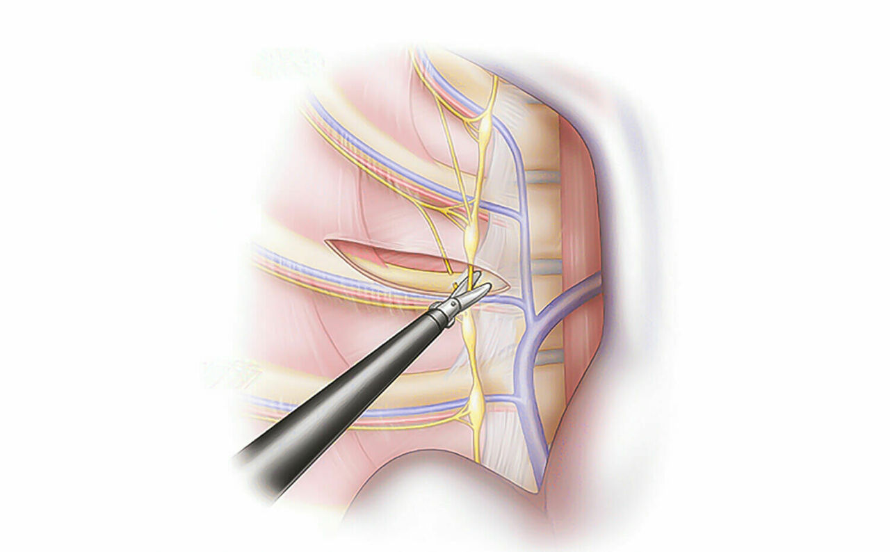 Ter Bezlerinin Alınması Zararlı Mıdır Ve Nasıl Yapılır Ter Bezleri Neden Alınır Ter Bezleri Nasıl Alınır (2)
