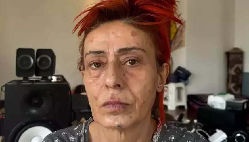 Yıldız Tilbe Yüzünü Yakmıştı, Maskeyle Gizlediği Son Hali Gündem Oldu! (4)