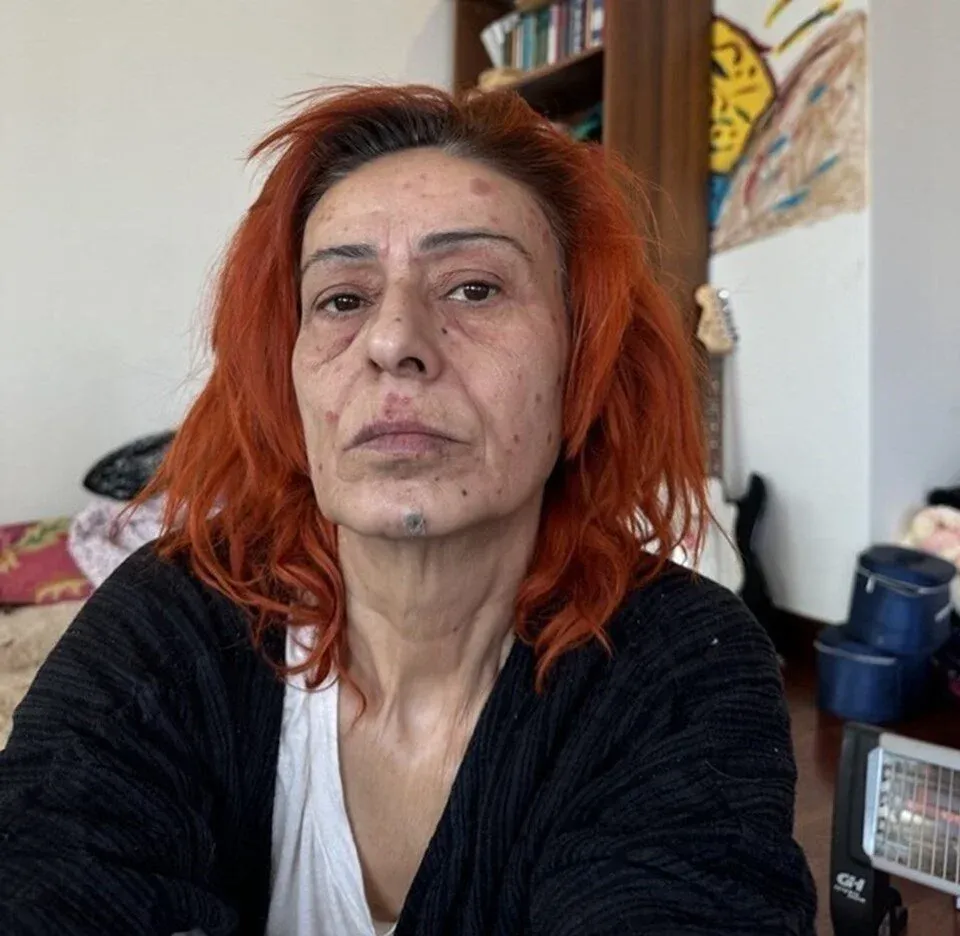 Yıldız Tilbe Yüzünü Yakmıştı, Maskeyle Gizlediği Son Hali Gündem Oldu! (5)