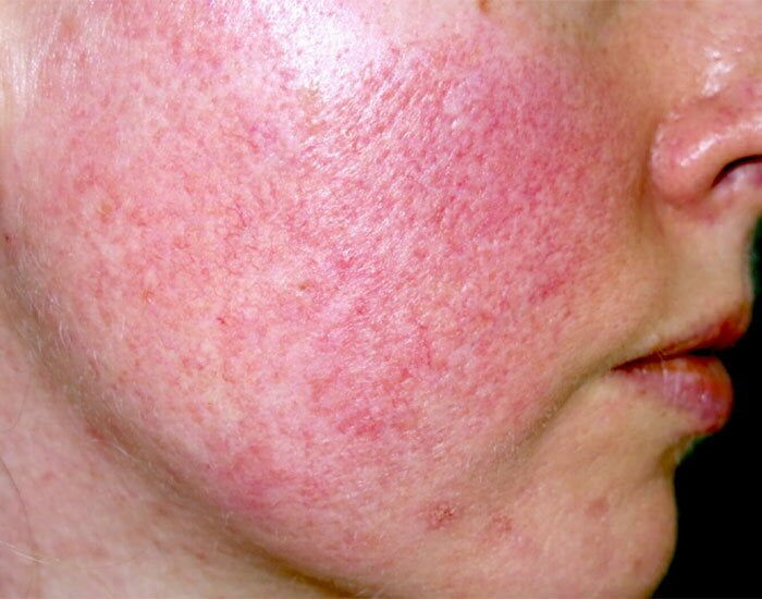 Ciltte Alev Alev Kızarıklık Ve Yanma Hissine Neden Olan Gül Hastalığı Nedir, Belirtileri Nelerdir (2)