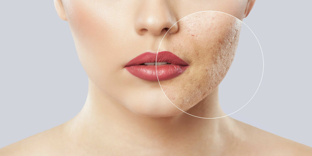 Elinde Ayna Ile Gezenlerin Korkulu Rüyası Mı Sivilce İzlerinden Kurtulmanın Etkili Yolları Nelerdir (1)