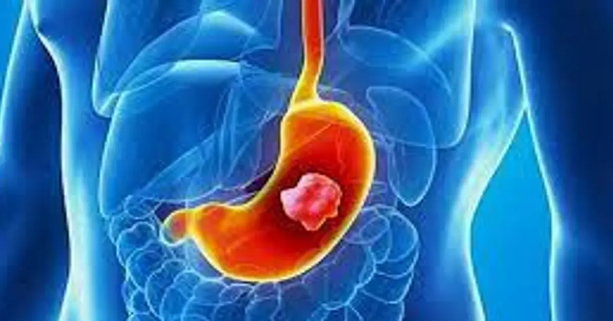 Genç Gazete Bu Belirtiler Mide Kanseri Habercisi Olabilir! Geç Kalmadan Dikkat Edin 2