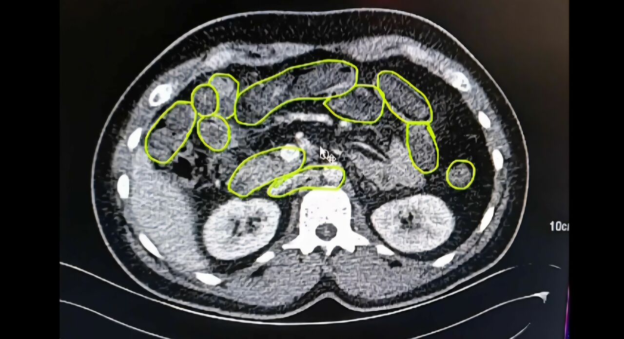 Mide Ve Bağırsaklarından Uyuşturucu Çıktı (4)