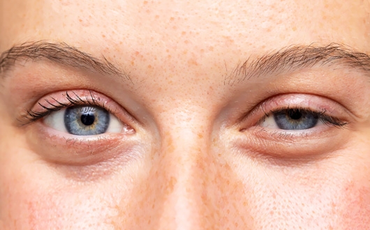 Goz Kapagi Dusuklugu 6