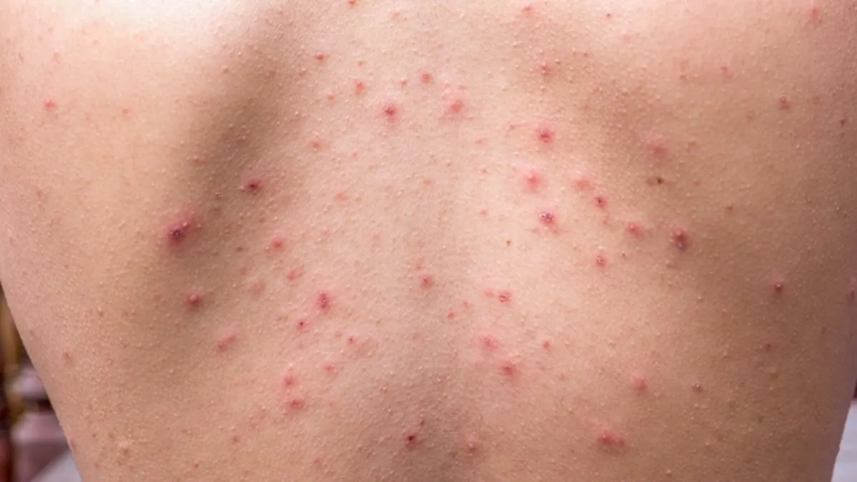 1200X675 Sirtta Cikan Sivilcelere Kesin Cozum Puruzsuz Bir Cilt Icin 1716212575647