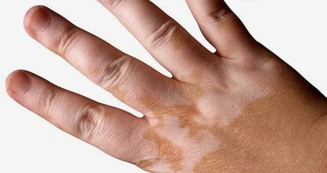 650X344 Addison Hastaligi Belirtileri Ve Tedavisi 1484209907317