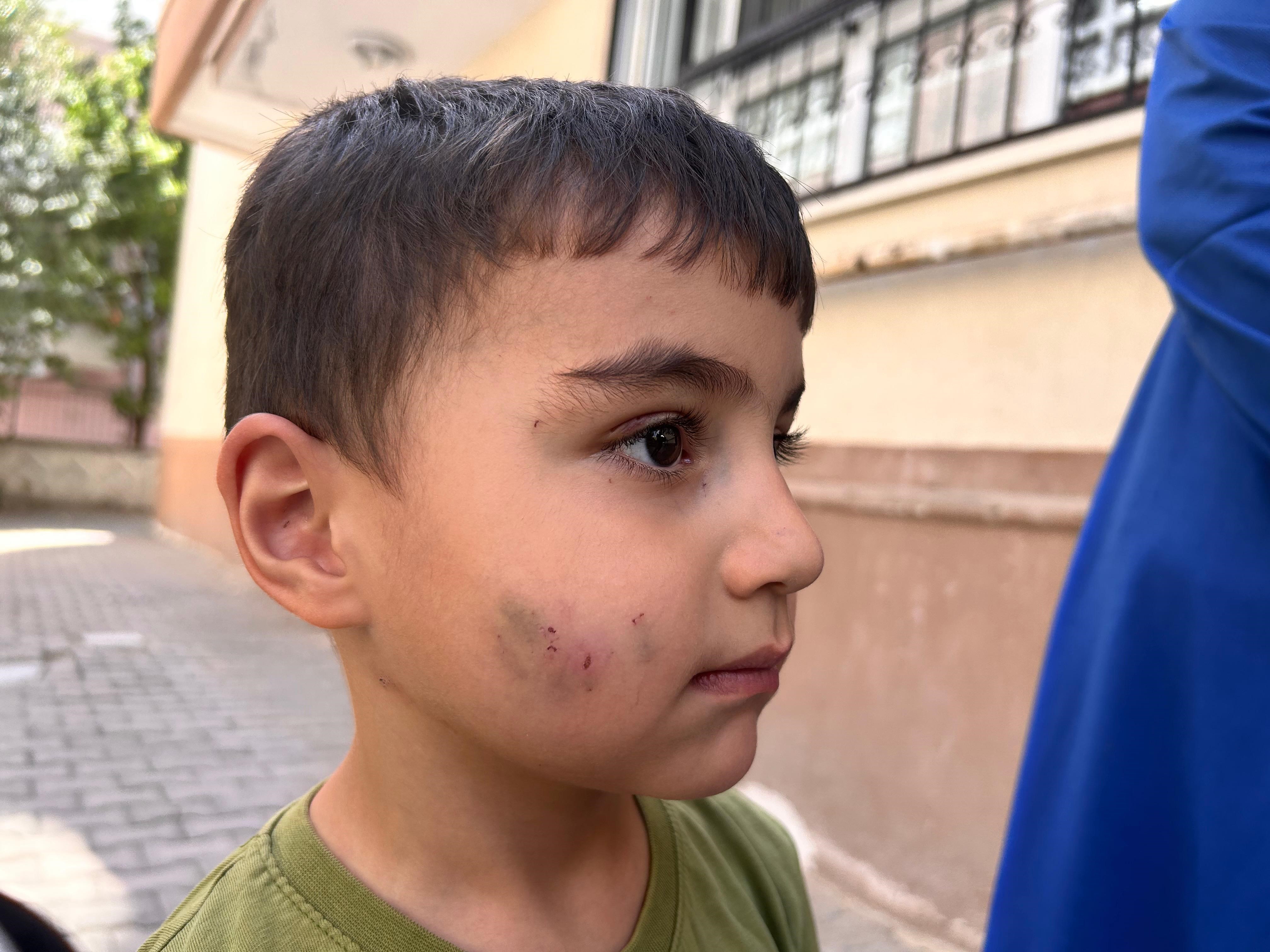 Ankara'da Evde Uyuyan Çocuğu Lağım Faresi Isırdı (2)