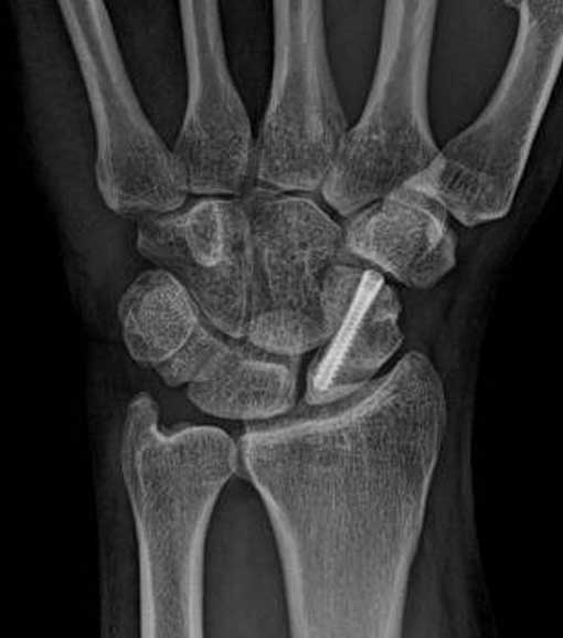 Bilek Ağrısı Küçük Bir Kırıktan Kaynaklanıyor Olabilir! Skafoid Kırığı Nedir Ve Nasıl Anlaşılır (4)