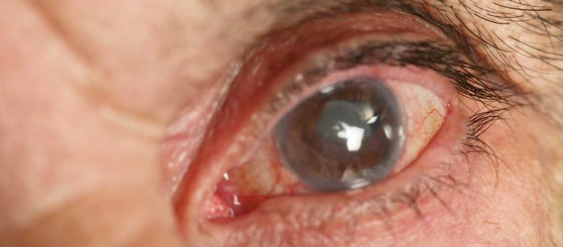 Bu Besinler Katarakt Riskini Azaltmaya Yardımcı Oluyor (1)-1