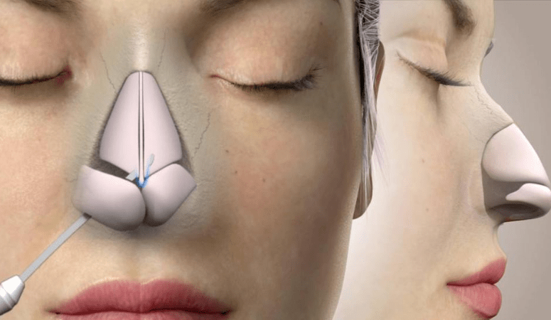 Burun Estetigi Sonrasi Burun Sekli 775X450