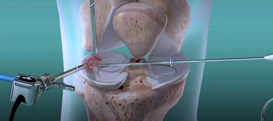 Eklem Hastalıklarında Artroskopi Cerrahisi Ile Iyileşmek Mümkün (2)