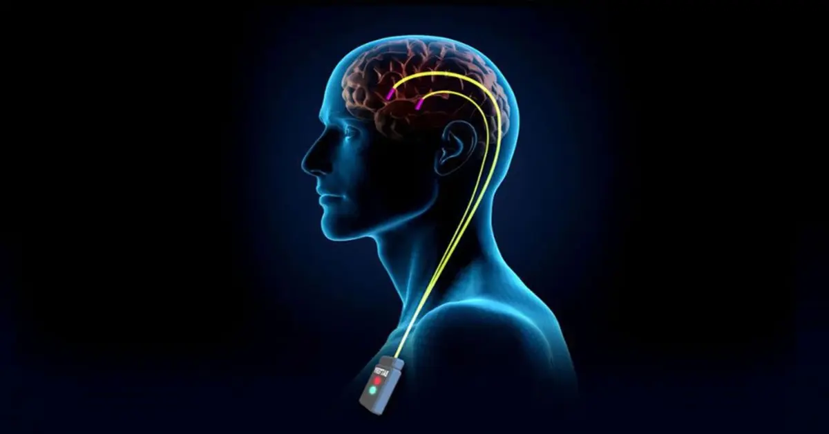 Genç Gazete Beyin Pili Nedir, Hangi Hastalıklarda Kullanılır Ve Ameliyatı Nasıl Yapılır 2