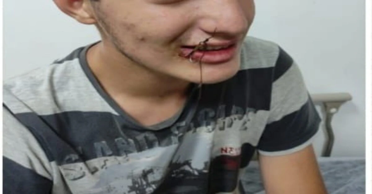 Genç Gazete Bursa’da 12 Yaşındaki Çocuğun Ağzına Oltanın İğnesi Takıldı, İtfaiye Kurtardı