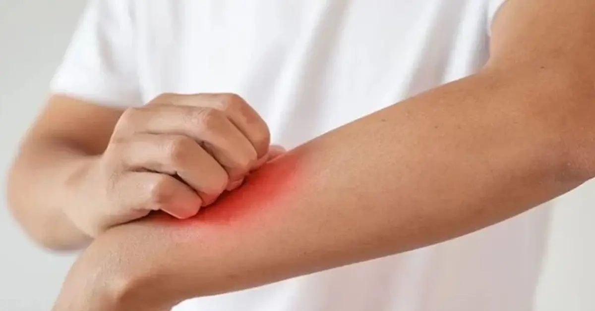 Genç Gazete Cildinizde Rengarenk Lekeler Mi Var, Kaşıntı Eşlik Ediyor Mu Yaşadığınız Şey Yaz Mantarı Olabilir Mi (2)