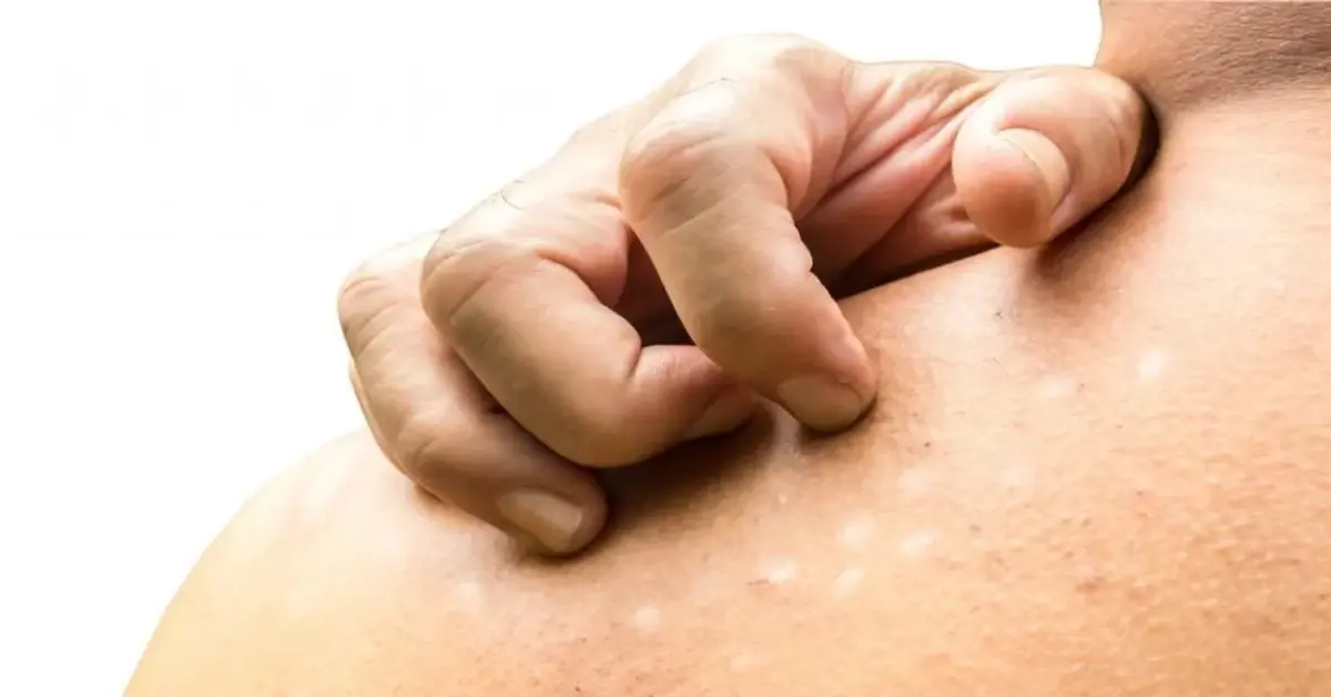 Genç Gazete Cildinizde Rengarenk Lekeler Mi Var, Kaşıntı Eşlik Ediyor Mu Yaşadığınız Şey Yaz Mantarı Olabilir Mi