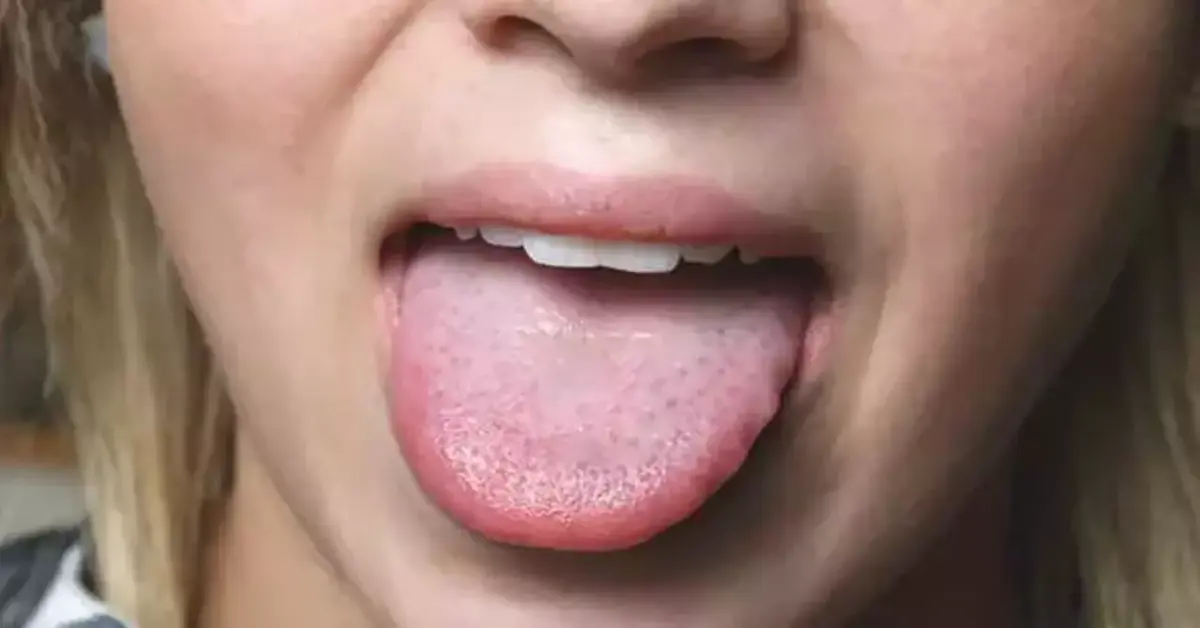 Genç Gazete Dilinizde Geçmeyen Yara Mı Var Ağrıyor, Yanıyorsa Dikkat! Dil Ülseri Nedir, Neden Olur Ve Nasıl Geçer 1